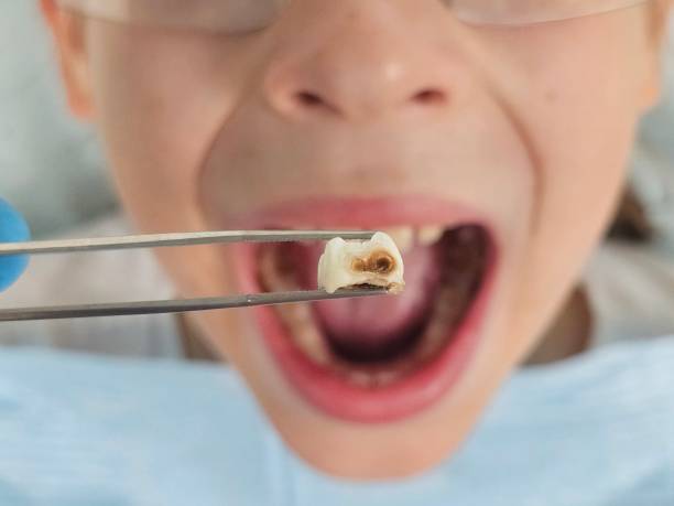 Best Emergency Treatment for Toothache in Warm Mineral Springs, FL