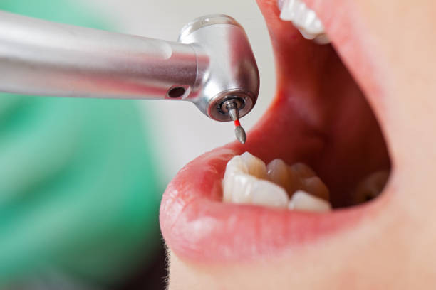 Best Emergency Tooth Extraction in Warm Mineral Springs, FL